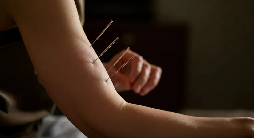 Acupuncture for anxiety and stress relief