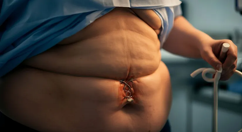 Benefits of bariatric surgery for obesity